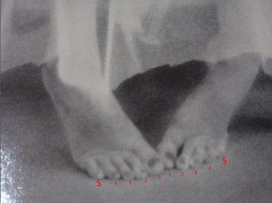 玛丽莲·梦露裸死床上现场照片（组图） 玛丽莲梦露有6只脚趾