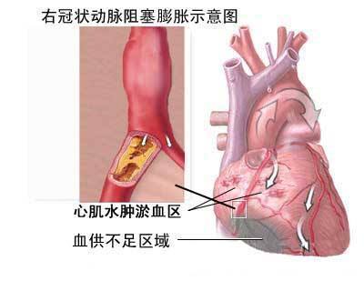 心脏供血不足，心肌缺血怎么办 怀孕心脏心肌缺血