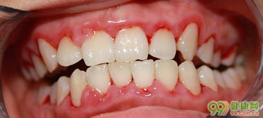 牙周炎有哪些症状 为什么会得牙周炎 牙周炎症状图片