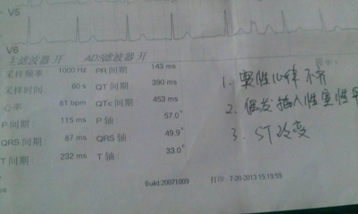 窦性心律不齐不是病？ 呼吸性窦性心律不齐