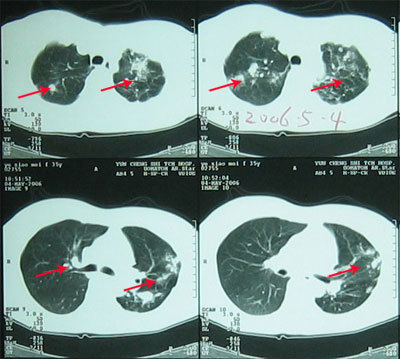 肺结核的早期症状 肺结核晚期能活多久