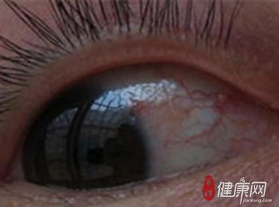 红眼病快速治疗方法是什么样的 红眼病多长时间能好