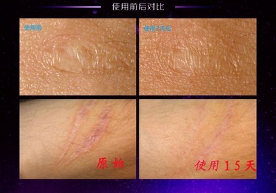 薰衣草精油去疤痕痘印的使用方法 去痘印疤痕的方法