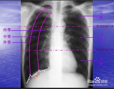 教你怎么看正常的胸片。 正常胸片