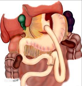 肠胃消化吸收功能不好怎么办 肠胃消化吸收不好