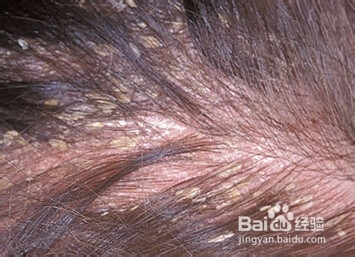 头皮屑多是什么原因？用了很多洗发水都没效果 无硅油洗发水 头皮屑