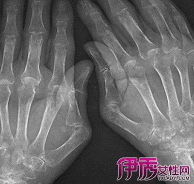 手指关节痛如何治疗 手指关节痛治疗偏方