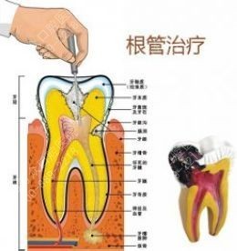 补牙齿的过程 根管治疗哪个环节最疼