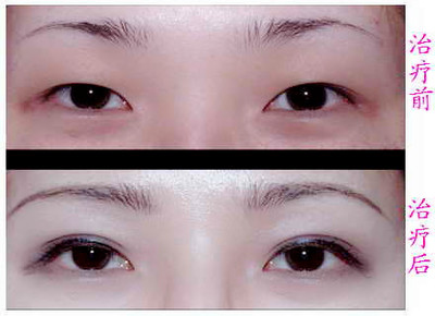 双眼皮手术后多长时间能恢复 做双眼皮手术恢复时间
