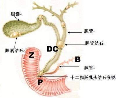 胆囊结石不可以吃什么 多发性胆囊结石治疗