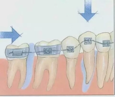 牙齿的结构（图解） 牙齿矫正的原理图解