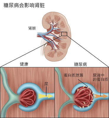 得了肾炎严重吗 肾炎严重吗 能治愈吗