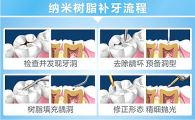 龋齿--补牙的过程 龋齿补牙后注意事项