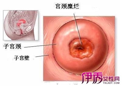 宫颈癌晚期能活多久 放化疗为什么死得更快