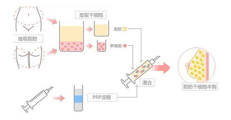 自体脂肪活细胞丰胸需谨慎 自体脂肪丰胸术后效果