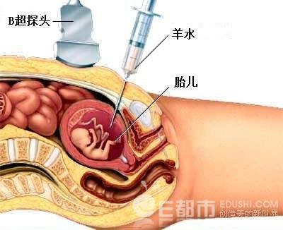 孕期做羊水穿刺需要注意些什么 羊水穿刺前注意事项