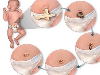 新生儿脐部的护理 新生儿脐部护理ppt