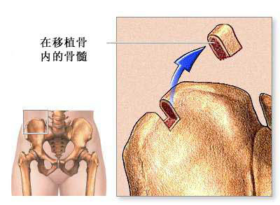 白血病骨髓移植无菌仓内日记I 白血病骨髓移植的原理