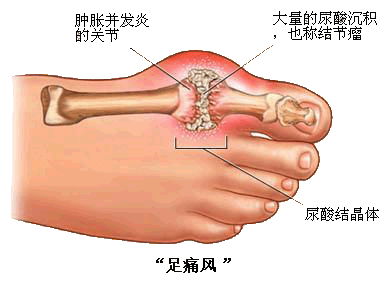 十味乳香散的效果如何？是真的吗？能治愈痛风吗？ 非布司他能治愈痛风吗