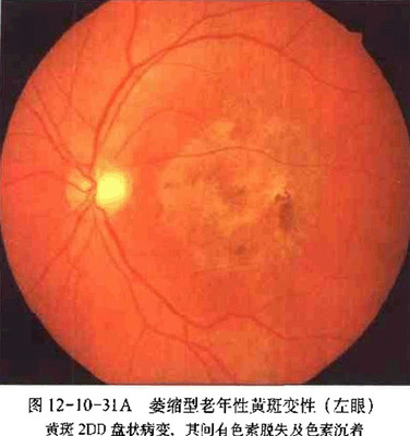 眼睛黄斑水肿的治疗方法 眼底黄斑水肿治疗方法