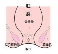 青岛九洲肛肠医院讲述女性为什么容易患肛裂 晋江九洲医院肛肠