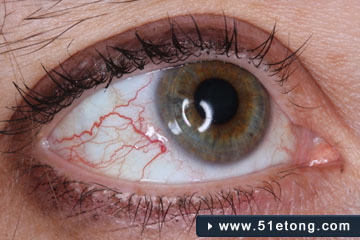 怎么治眼睛里的红血丝 眼睛有红血丝怎么消除