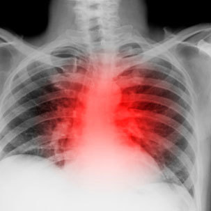 支原体肺炎是常见的感染性疾病 泌尿感染性疾病