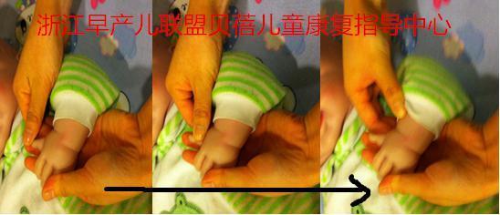 拇指内扣成因及其推拿疗法 宝宝大拇指内扣图片