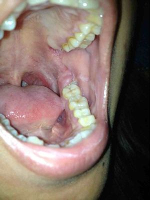 牙齿松动，牙龈肿痛怎么办 牙齿最里面牙龈肿痛