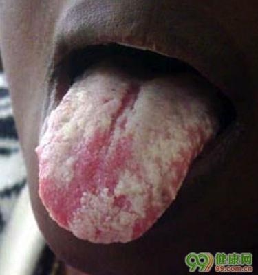 艾滋病的口腔病损 口腔发白一定是艾滋病