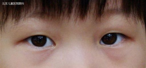 遭遇小儿过敏性角膜炎 过敏性角膜炎的症状