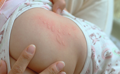 常见的过敏性荨麻疹的表现症状 小儿荨麻疹症状图片