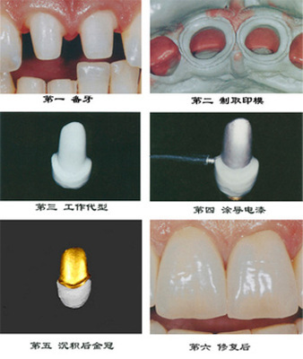 关于牙龈萎缩 整牙的过程