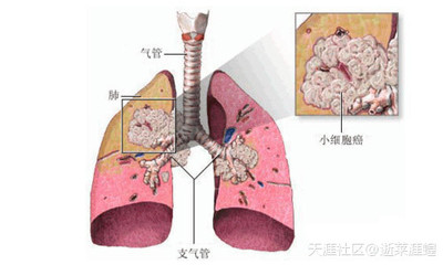 [转载]肺癌病人的饮食低分化肺腺癌 高分化肺腺癌