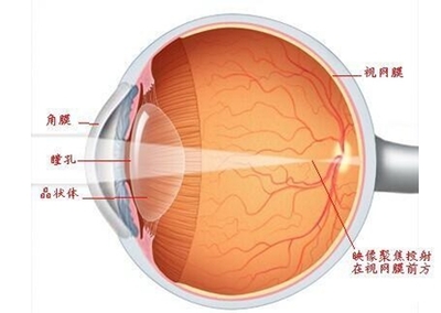 小孩视网膜脱落的原因 视网膜脱落是什么原因