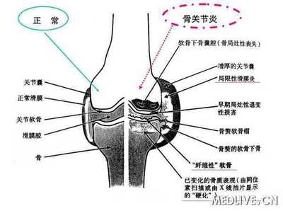 膝关节积液特效验方 骨关节积液怎么治疗