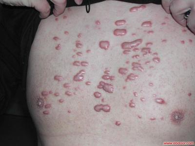 痘痘的种类和形成的原因以及如何治疗。 痘痘种类及治疗方法