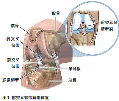 膝关节前交叉韧带断裂的康复（韧带功能和损伤机制） 膝关节前交叉韧带断裂