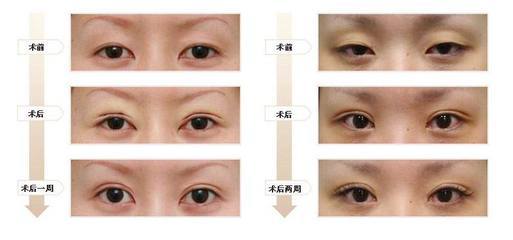 北京双眼皮手术医院哪家最好 双眼皮手术哪家医院