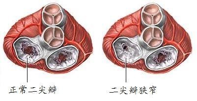 心脏瓣膜病二尖瓣膜狭窄的早期症状是什么？ 心脏瓣膜狭窄怎么治疗