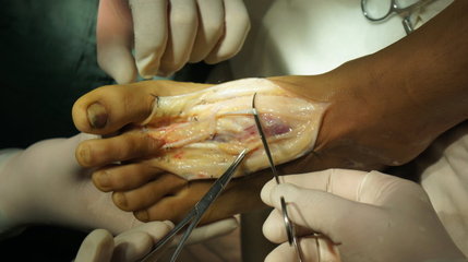 三天前做的一个二脚趾头搬家再造拇指！（手术照片，慎入！） 大拇指脚趾头麻木