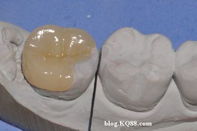 高嵌体，牙齿修复的新选择 牙齿嵌体修复疼么