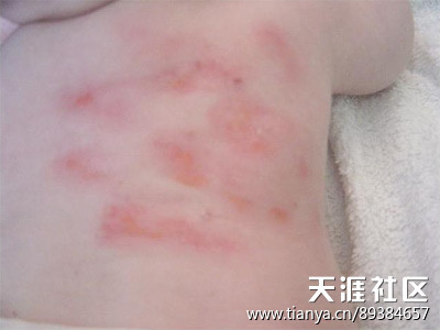 常见的小儿湿疹症状表现 皮肤湿疹症状表现