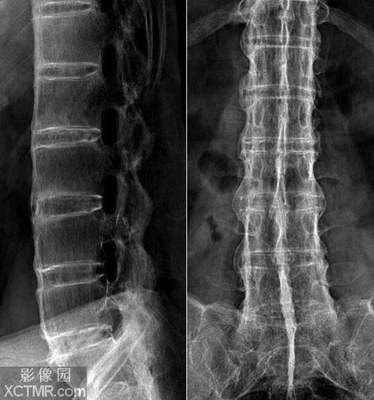 关于强直性脊柱炎，我的一点体会 强直性脊柱炎怎么治