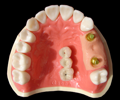 镶牙过程是怎样的？ 镶牙过程图解