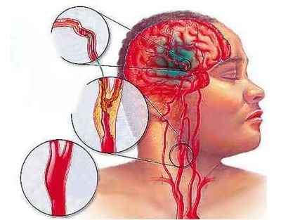 脑梗塞引起的原因 脑梗塞发生的八大前兆