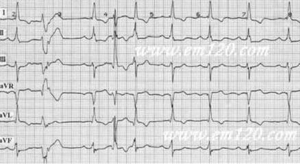 心脏各壁心梗的心电图都在哪些导联? 前壁心梗心电图