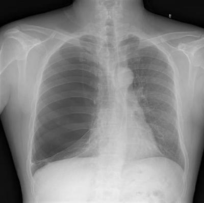 原发性气胸的早期症状 原发性肺癌早期症状