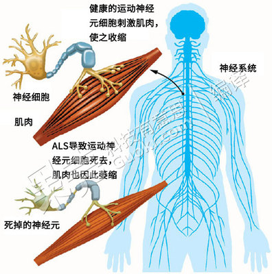 一个神经内科医生眼中的ALS 神经内科医生咨询