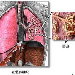 闭塞性毛细支气管炎介绍 毛细支气管肺炎